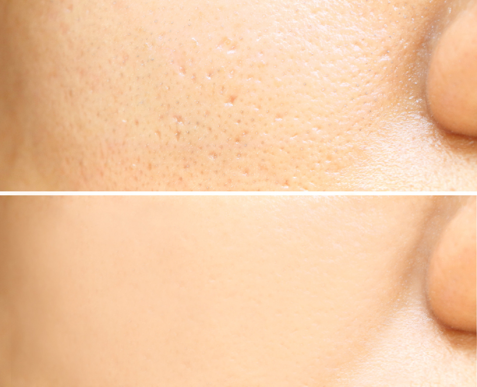7 Best Facials for Oily Skin