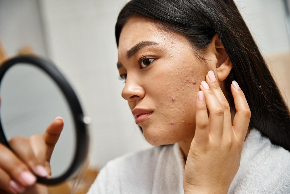 How to Get Rid of Acne Scars And Why Your Approach Needs to Match Your Scar Type