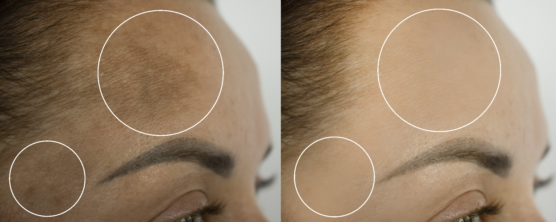 Best Facial for Pigmentation: Which Treatment Is Right for Your Skin?